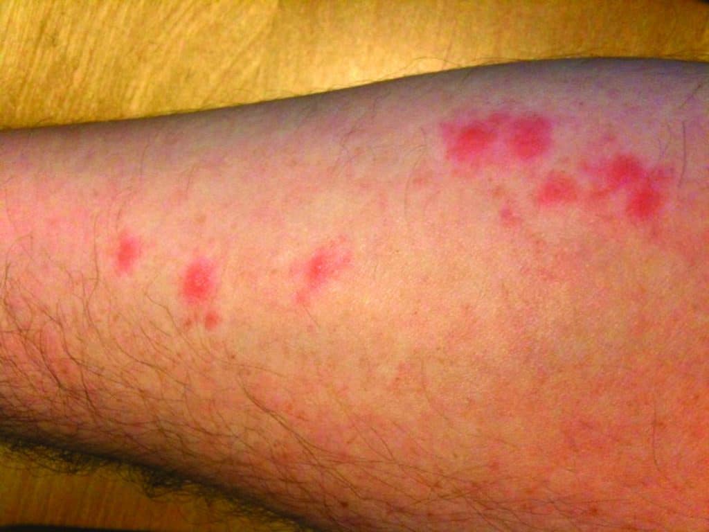 Bed Bug Bites