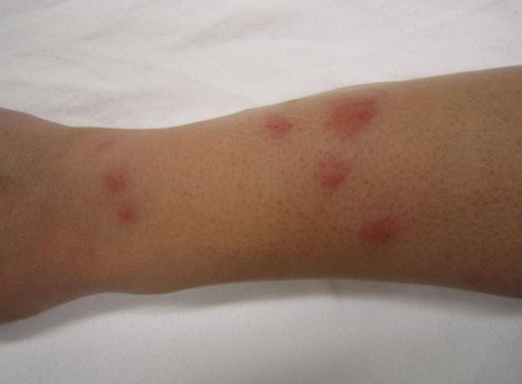 bed bug bites